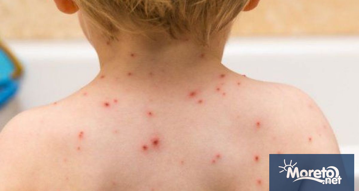 Случаите на новозаразени с варицела във Варна и областта бележат