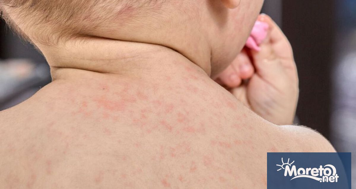 Случаите на заболели от скарлатина във Варна растат с особено