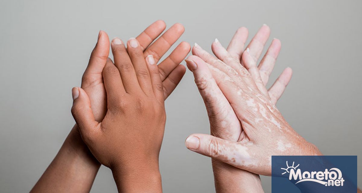 25 юни е обявен за Световен ден на витилиго