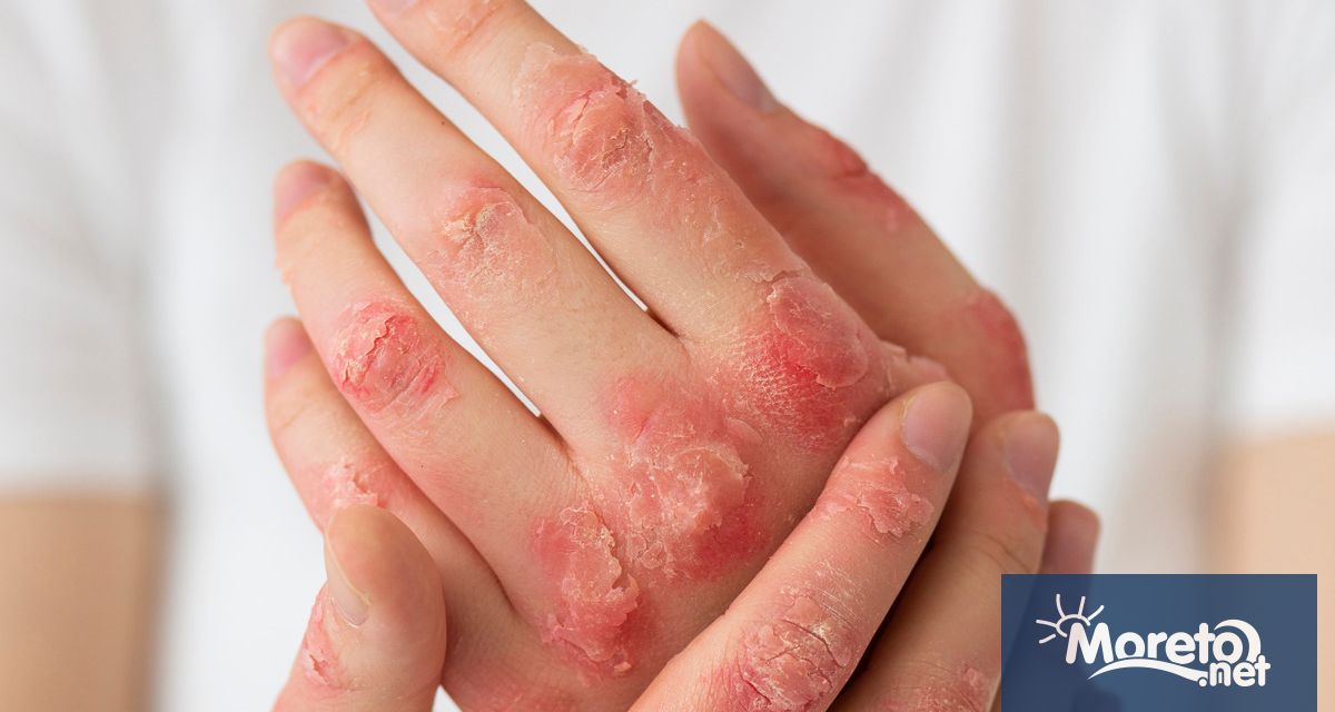Псориазисът е хронично автоимунно заболяване което кара кожните клетки да