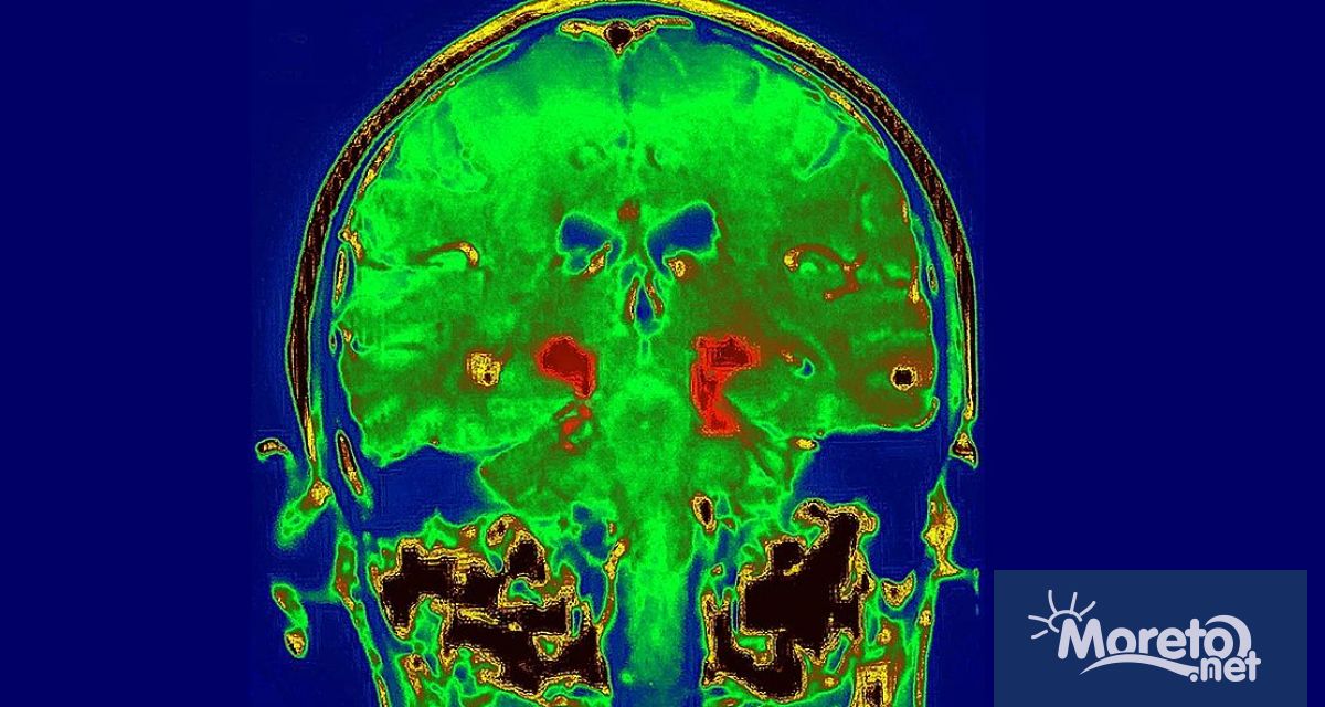 Лекарство за диабет наречено ликсисенатид показа обещаващо забавяне на прогресията