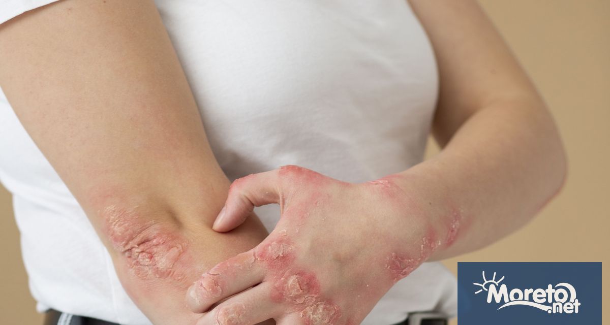 Псориазисът е хронично автоимунно заболяване което кара кожните клетки да