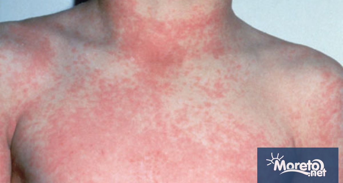 Сериозен скок на случаите на скарлатина във Варна и областта