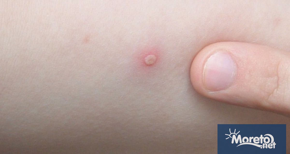 Увеличават се случаите на лица с варицела във Варненско научи