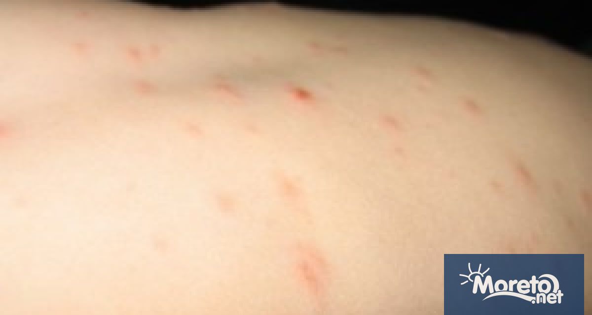 Увеличават се случаите на варицела в област Варна сочи справка