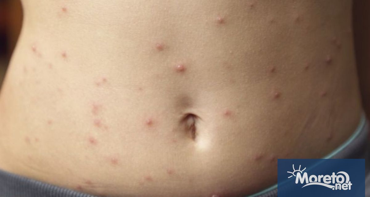 Първи случай на морбили е регистриран у нас в Националния