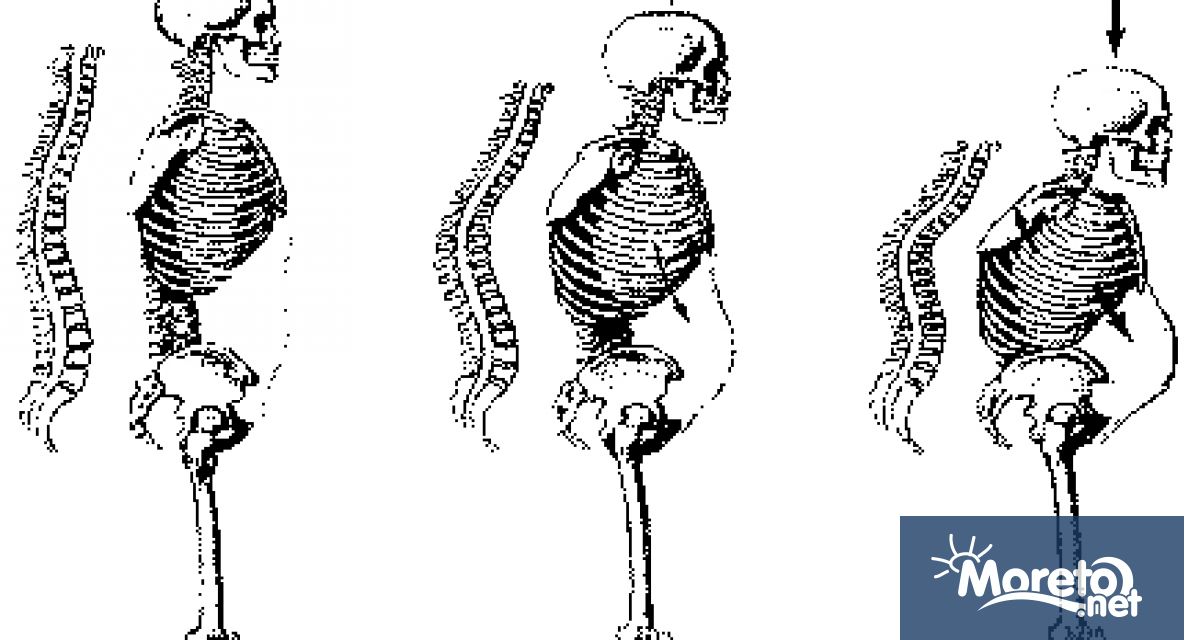 Днес отбелязваме Световния ден за борба с остеопорозата Това е